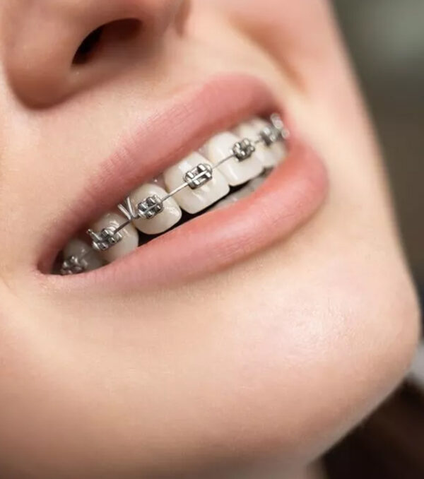 Orthodontics - Braces